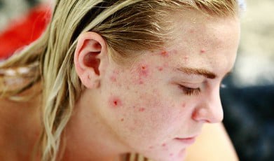 hautunreinheit bergkristall-signaturstab-h2detox